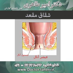 شقاق-مقعد