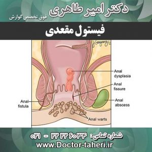 فیستول مقعدی