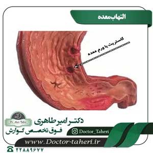 التهاب معده