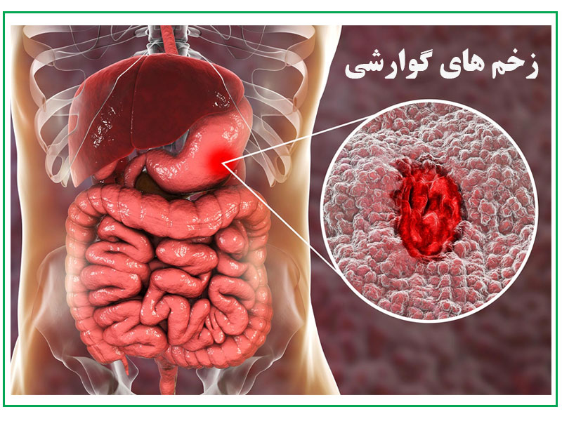 زخم های گوارشی