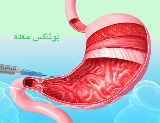 عوارض بوتاکس معده