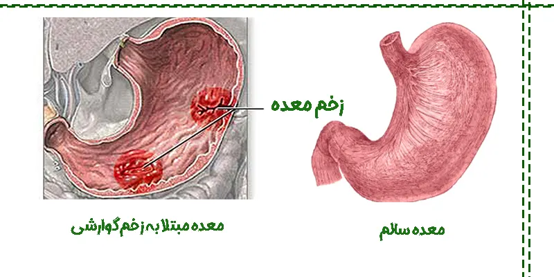 زخم های گوارشی