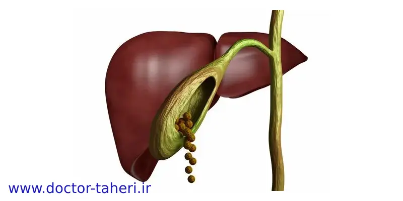 مصرف سبزیجات برای پیشگیری از سنگ صفرا مصرف سبزیجات برای پیشگیری از سنگ صفرا