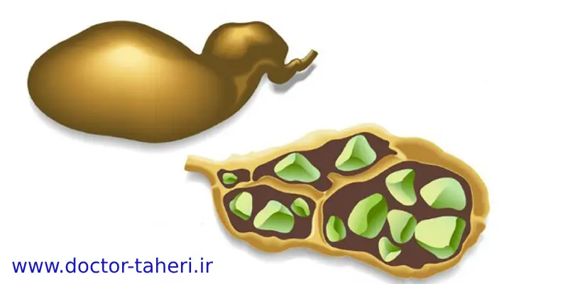 مصرف میوه برای پیشگیری از سنگ صفرا مصرف میوه برای پیشگیری از سنگ صفرا