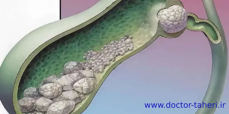 پیشگیری از سنگ صفرا پیشگیری از سنگ صفرا