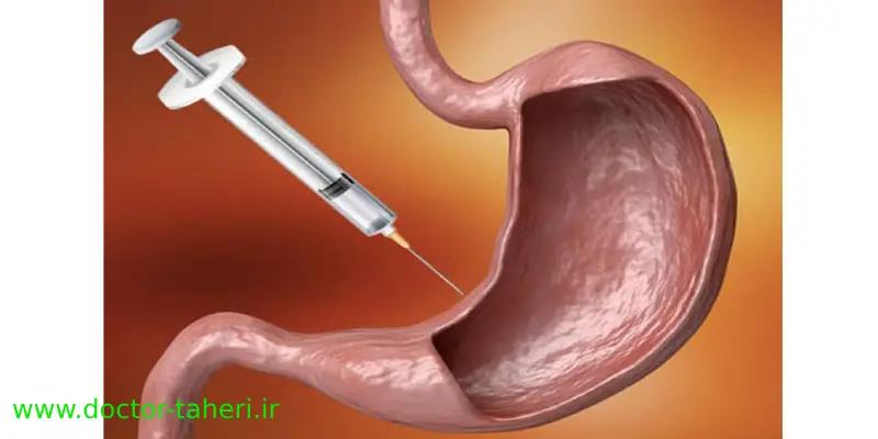 بوتاکس معده بهتره یا بالن