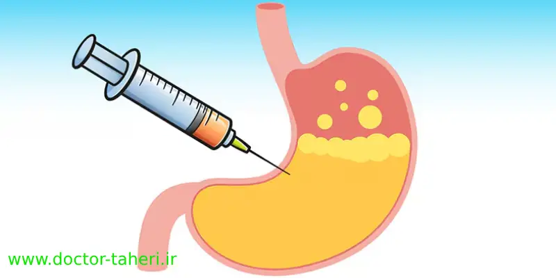 بوتاکس معده ماندگاری بیشتری دارد یا بالون معده؟